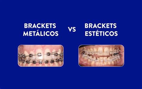 brackets esteticos vs metalicos|brackets autoligados.